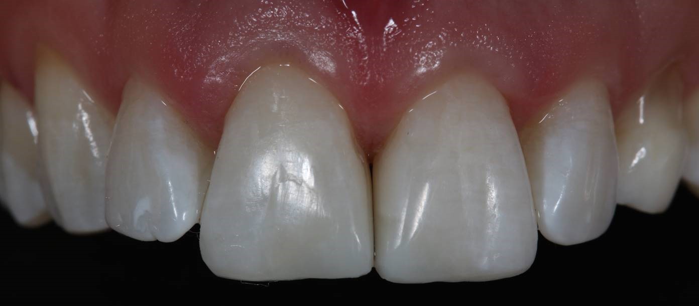 The Use Of Lasers In Dentistry Gingivectomy By Diode Laser Optident